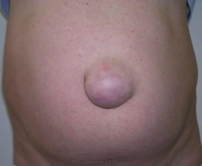 Triệu chứng thoát vị rốn đã gây biến chứng nghẹt